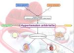 L hypertension artrielle - Symptmes et traitement - Doctissimo