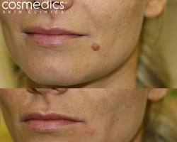 Image of before and after laser mole removal