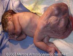 Image result for teratoma