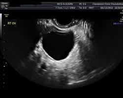 Image of Ultrasound of an ovarian cyst