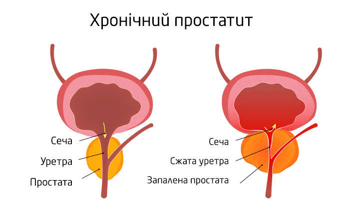 Хронічний простатит | Симптоми, причини, лікування у ...