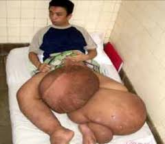 Image result for Filariasis / Penyakit Kaki Gajah