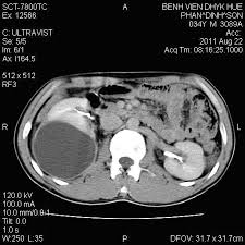 Kết quả hình ảnh cho Nang thận