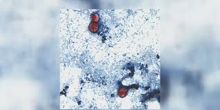 Kansas cyclosporiasis cases rise to 289 in Wednesday’s report