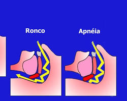 Imagem de Apneia obstrutiva do sono