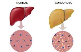 Resultado de imagem para gordura no figado