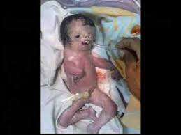 Image result for depleted+uranium+babies