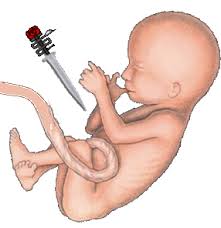 Resultado de imagem para aborto