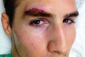 At the post-fight press conference for UFC on Fox 4, Dana White announced that Rory MacDonald sustained a cut above his left eye requiring “38, 48 stitches” ... - rory