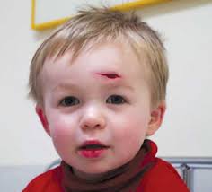 Image result for laceration