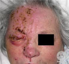 Image result for "Herpes Zoster"