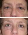 Getting Rid Of Under Eyelid Festoons