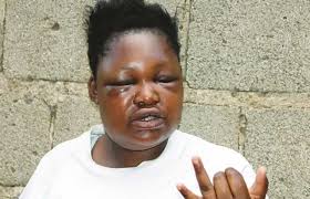 Doctors have told Miss Siphathisiwe Sibanda (22) that she may never fully regain her eyesight after the savage beating on the night of 16 November. - SIPHATHISIWE-SIBANDA