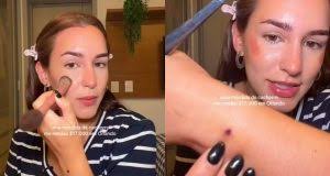 Mordida de poodle deixa influencer brasileira com cobrança hospitalar de R$ 84mil nos EUA