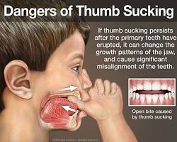 Image of Thumb Sucking