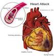 Herzinfarkt - Jede Minute z hlt - Infofilm -