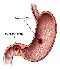 Image result for Duodenal Ulcer