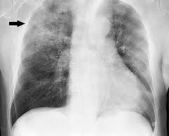 Image of Pneumonia lungs
