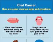 Image of Oral Cancer