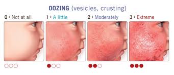 Resultado de imagen para dermatitis