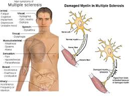 Image result for what is multiple sclerosis symptoms Cognitive Problems