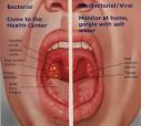 Is tonsillitis contagious? - WebMD 