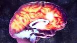  One concussion could increase risk of Parkinson's disease, study says