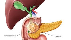 Scientists cure pancreatic cancer in mice. Could it work in humans?