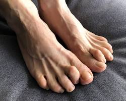 Hammertoes