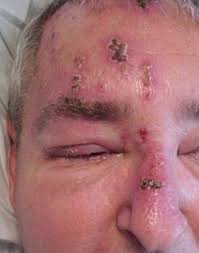 Image result for "Herpes Zoster"