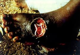 무서운이야기 - [약혐]숙주를 조정하는 기생충( 메디나충 ) : images?q=tbn:ANd9GcRWe7LRolX24a5ltc4KbCD8XAW5kXP_rD7cFb_Fa-afoFekz0gR