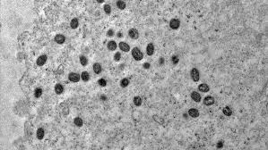 Paciente de 19 anos é internada e isolada com suspeita de monkeypox em Mossoró