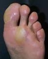 Tinea cure - Toes Feet - CoolRunning Forums