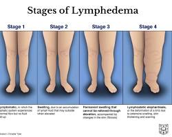 Image of Lymphedema leg