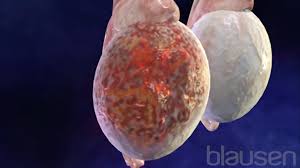 Image result for cancer du testicule