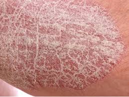 Image result for PSORIASIS