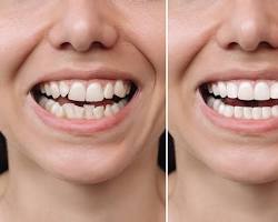 Image of person with misaligned teeth before and after receiving veneers