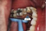 Les remdes de grand-mres contre le mal de dents - Allodocteurs