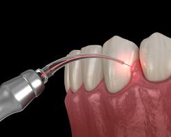 Image of laser dentistry procedure