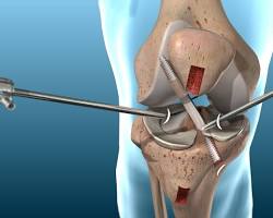 ACL reconstruction surgeryの画像