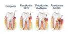 Cura la parodontite - Microdentistry