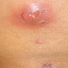 Image result for carbuncle