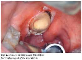 Image result for tonsil stones
