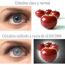 Resultado de imagen para Glaucoma: