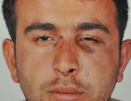 Otomobille gezerken kaza yapan 24 yaşındaki Bekir Koçyiğit, yaralanan arkadaşı Aziz Çınar&#39;la birlikte Devlet Hastanesi acil servisine gitti. - screen-shot-2012-06-25-at-3.29.00-pm