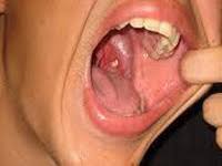 Image result for tonsil syringe