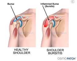 Image of shoulder bursitis