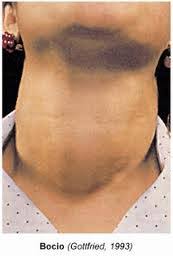 Resultado de imagen para bocio de riedel