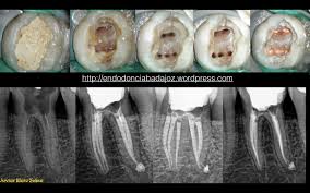 Resultado de imagen para obturacion lateral en endodoncia