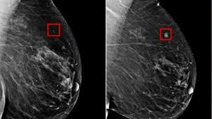 

AI-Powered Early Detection of Breast Cancer